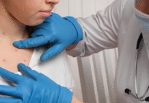 Sarampión en México: 11 mil casos y 32 muertes